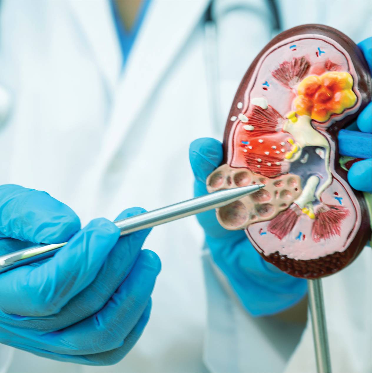 Doctor with a model of a kidney showing areas with the organ
