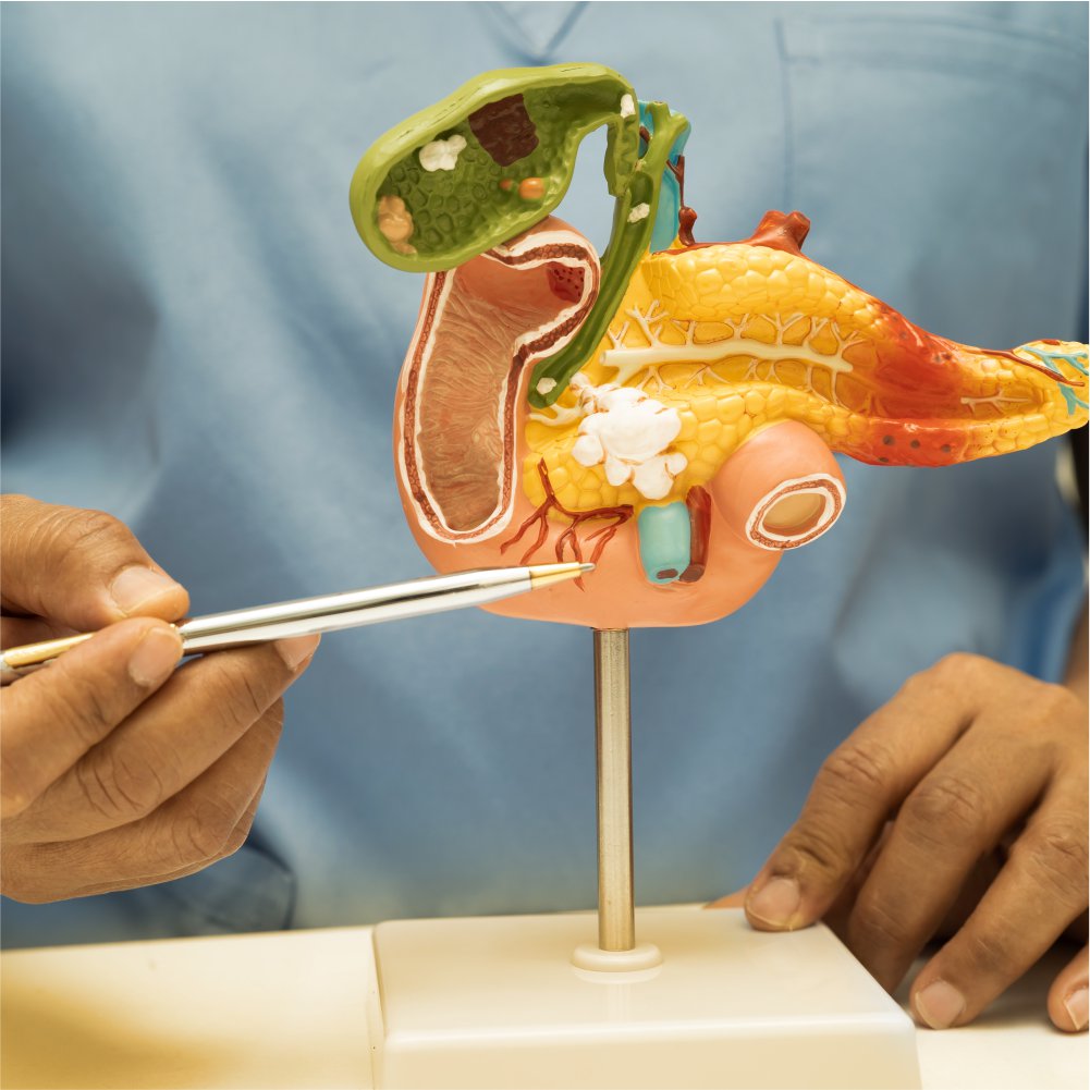 Diabetes is a condition in which your body is unable to use the glucose from the food you eat